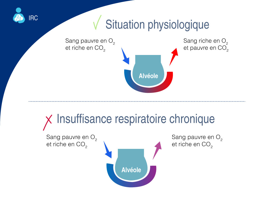 Insuffisance respiratoire chronique